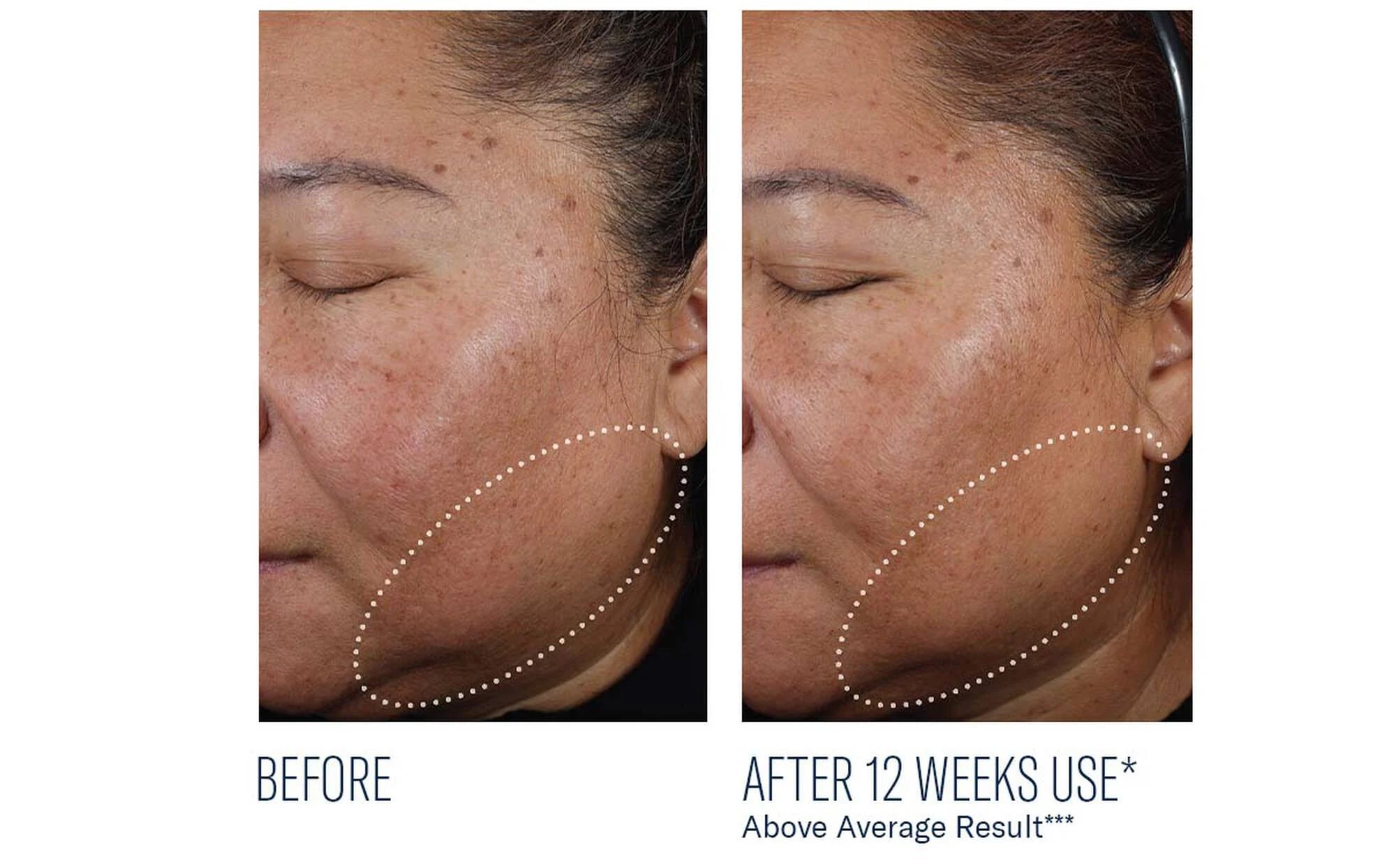 Before and after comparison of a woman's face with acne treatment showing visible improvement.